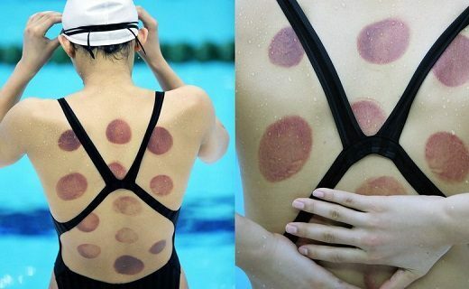 5-benefits-of-cupping-therapy-everyone-should-know-520x320-6165349