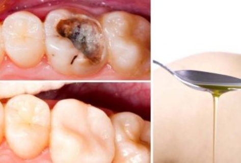 4-steps-reduce-tooth-decay-naturally-358x242-6590229