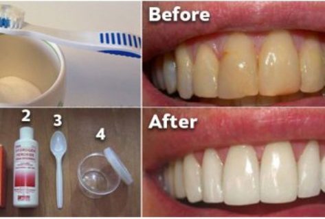 how-to-get-rid-of-plaque-and-whiten-your-teeth-without-expensive-treatments-358x242-6969562