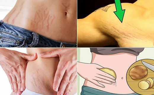 remove-stretch-marks-naturally-520x320-7362993