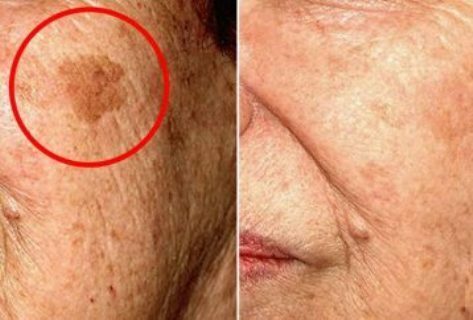 5-home-remedies-remove-type-skin-spot-face-358x242-4458080